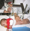 baby hip examination by Professor Dr. Graf